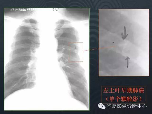 【PPT】小肺癌的影像表现及鉴别诊断