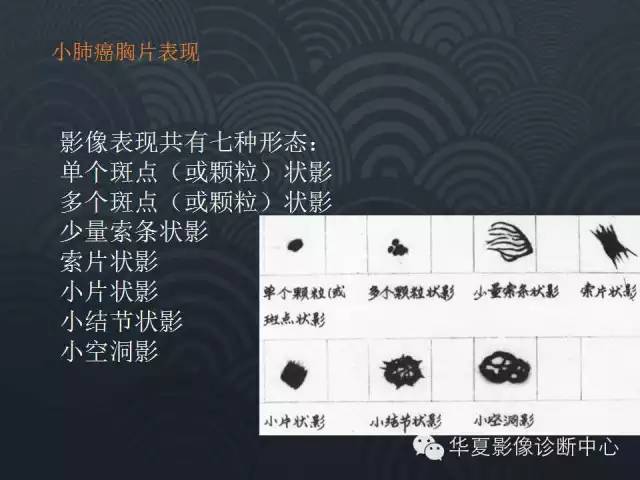【PPT】小肺癌的影像表现及鉴别诊断