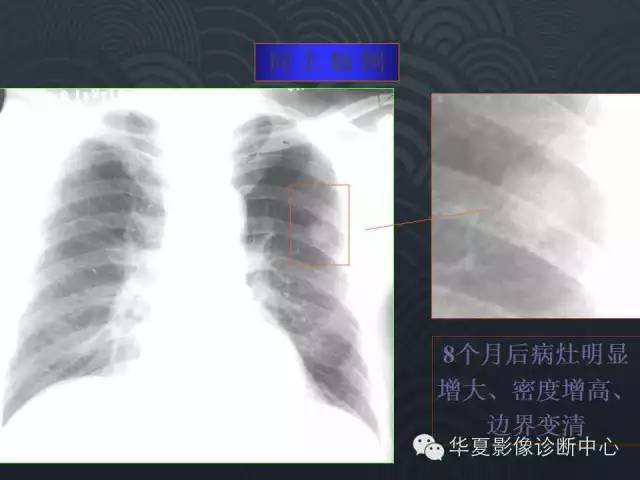【PPT】小肺癌的影像表现及鉴别诊断