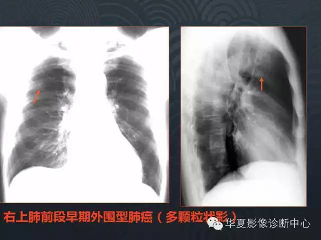 【PPT】小肺癌的影像表现及鉴别诊断