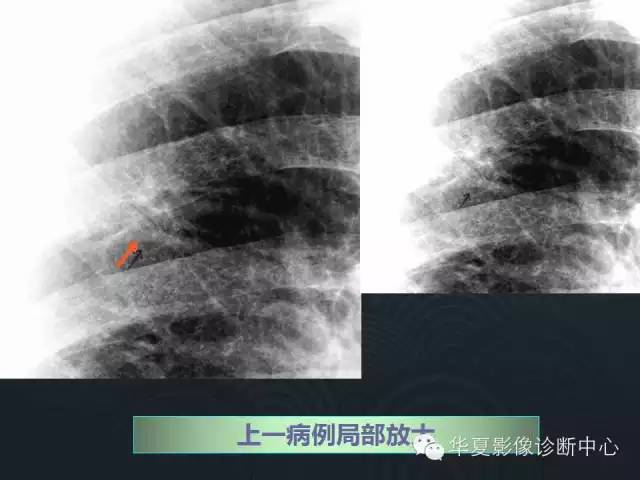 【PPT】小肺癌的影像表现及鉴别诊断