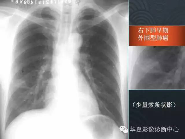 【PPT】小肺癌的影像表现及鉴别诊断