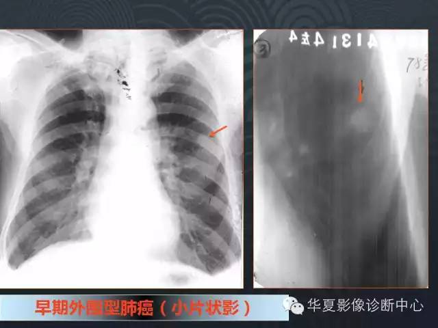 【PPT】小肺癌的影像表现及鉴别诊断