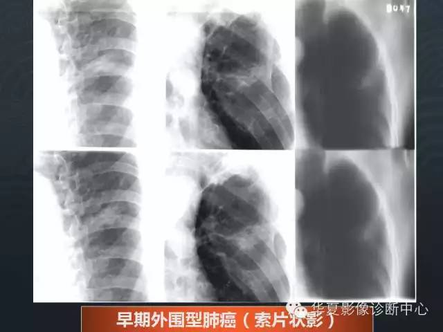 【PPT】小肺癌的影像表现及鉴别诊断