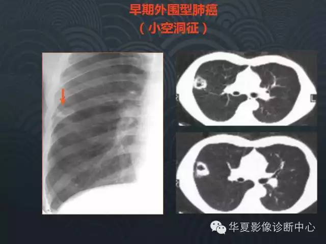 【PPT】小肺癌的影像表现及鉴别诊断