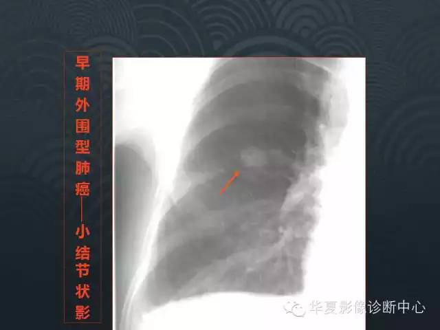 【PPT】小肺癌的影像表现及鉴别诊断