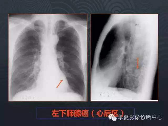 【PPT】小肺癌的影像表现及鉴别诊断