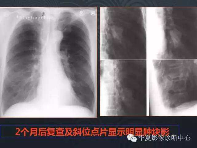 【PPT】小肺癌的影像表现及鉴别诊断