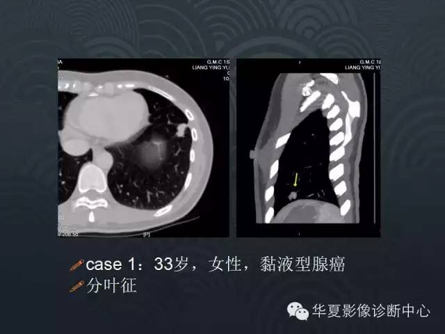 【PPT】小肺癌的影像表现及鉴别诊断