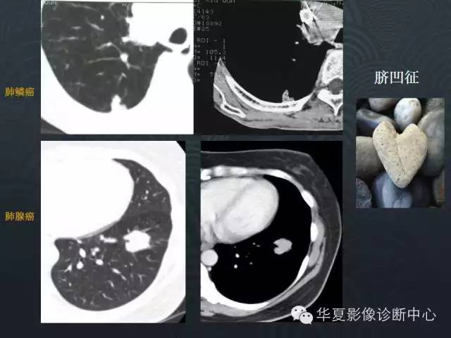 【PPT】小肺癌的影像表现及鉴别诊断