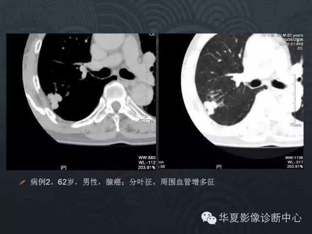 【PPT】小肺癌的影像表现及鉴别诊断
