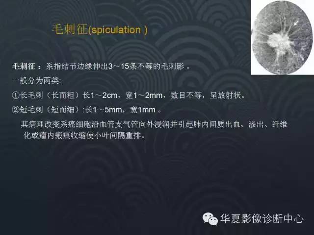 【PPT】小肺癌的影像表现及鉴别诊断