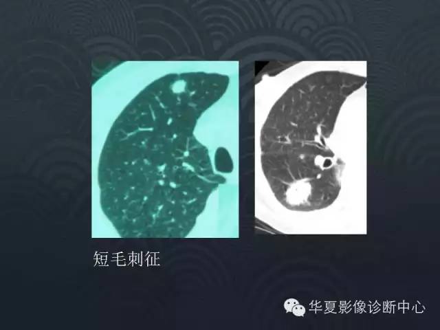 【PPT】小肺癌的影像表现及鉴别诊断