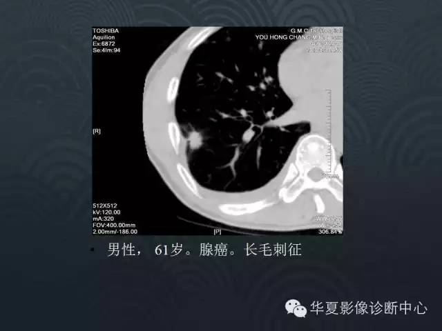 【PPT】小肺癌的影像表现及鉴别诊断