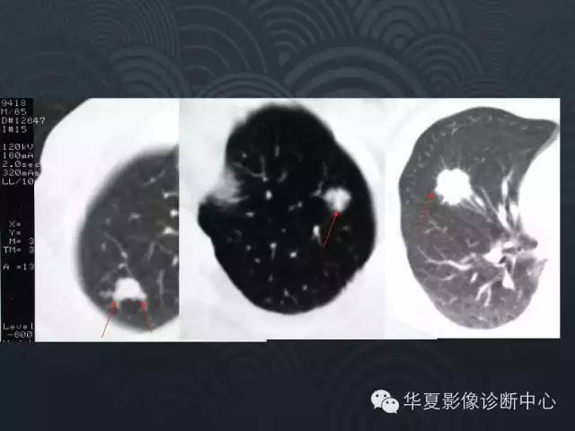【PPT】小肺癌的影像表现及鉴别诊断