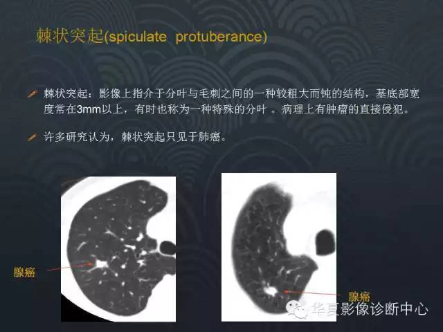 【PPT】小肺癌的影像表现及鉴别诊断