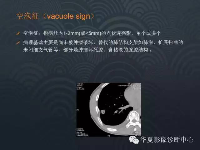【PPT】小肺癌的影像表现及鉴别诊断