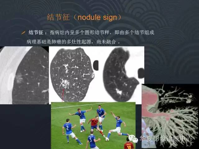 【PPT】小肺癌的影像表现及鉴别诊断