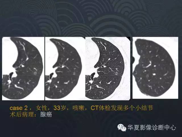 【PPT】小肺癌的影像表现及鉴别诊断