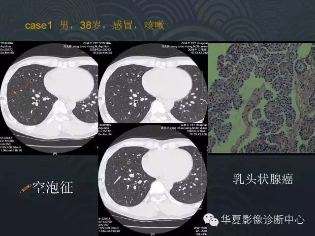 【PPT】小肺癌的影像表现及鉴别诊断