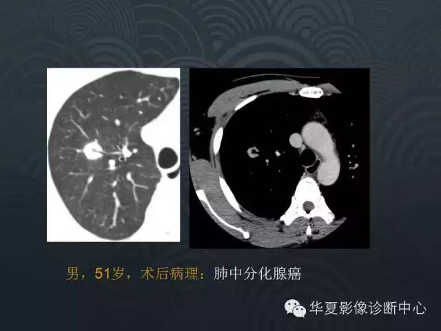 【PPT】小肺癌的影像表现及鉴别诊断