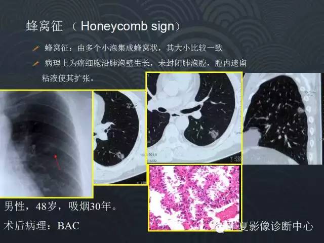 【PPT】小肺癌的影像表现及鉴别诊断