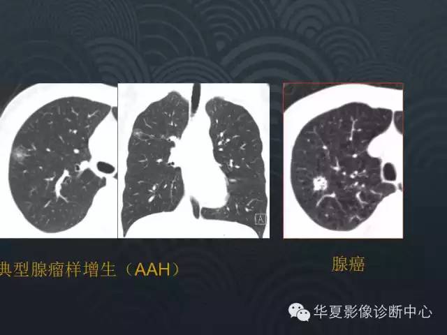 【PPT】小肺癌的影像表现及鉴别诊断