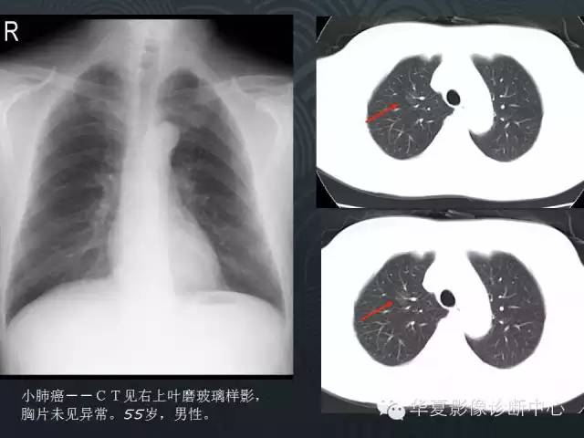 【PPT】小肺癌的影像表现及鉴别诊断