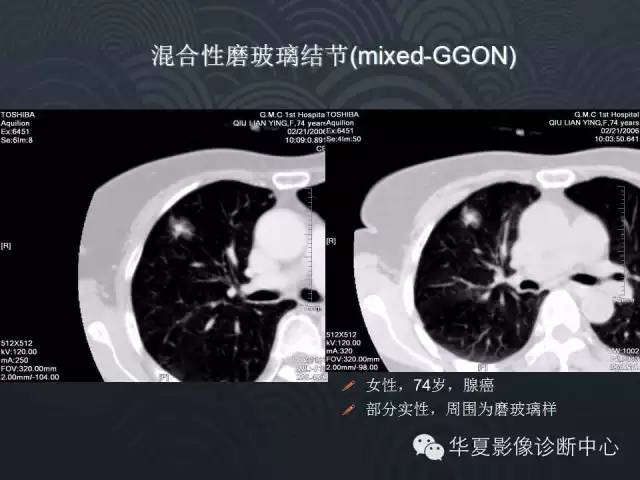 【PPT】小肺癌的影像表现及鉴别诊断