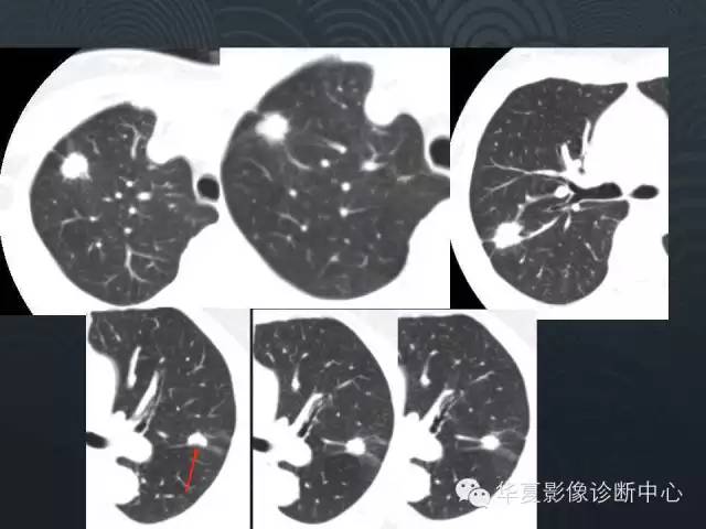 【PPT】小肺癌的影像表现及鉴别诊断