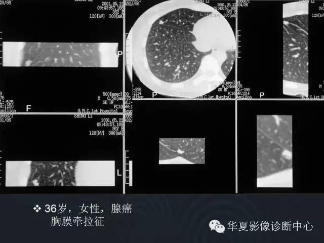 【PPT】小肺癌的影像表现及鉴别诊断