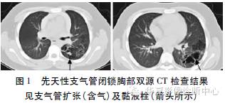 【病例】先天性支气管闭锁1例CT影像表现