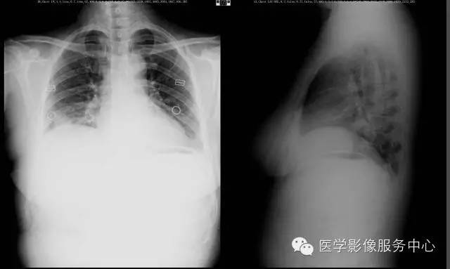 【病例】右下肺乳头状腺癌1例CT影像表现 【病例】右下肺乳头状腺癌1例CT影像表现