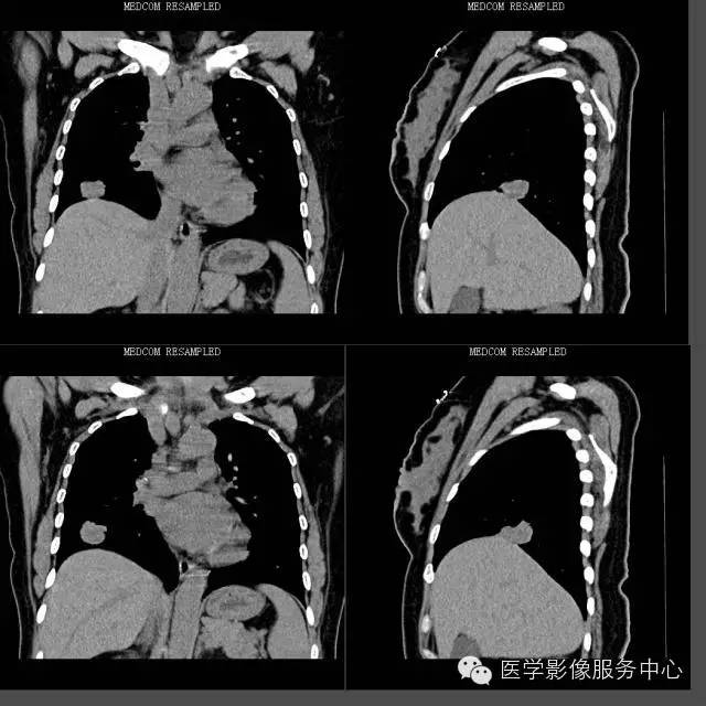 【病例】右下肺乳头状腺癌1例CT影像表现 【病例】右下肺乳头状腺癌1例CT影像表现
