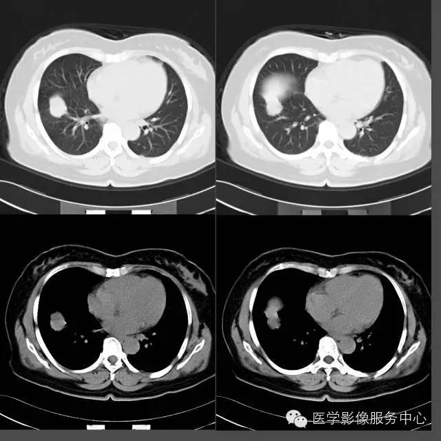 【病例】右下肺乳头状腺癌1例CT影像表现 【病例】右下肺乳头状腺癌1例CT影像表现