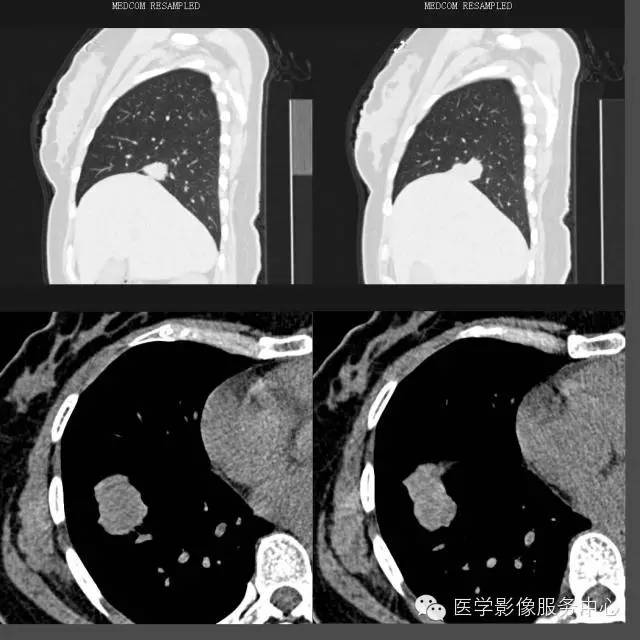【病例】右下肺乳头状腺癌1例CT影像表现 【病例】右下肺乳头状腺癌1例CT影像表现