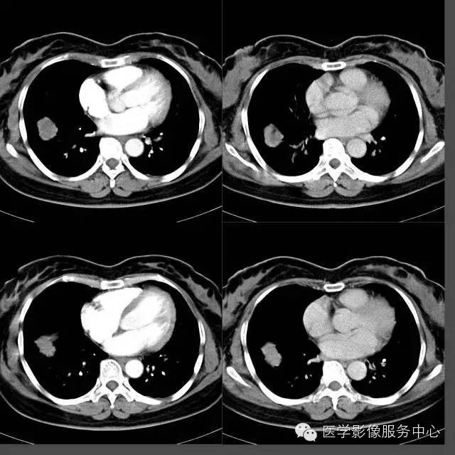 【病例】右下肺乳头状腺癌1例CT影像表现 【病例】右下肺乳头状腺癌1例CT影像表现