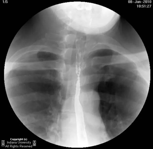 【病例】食管壁内假性憩室并长节段狭窄1例