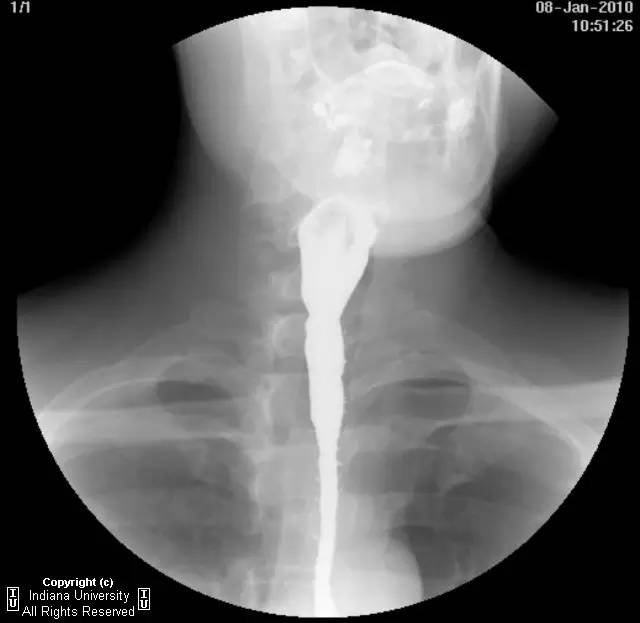 【病例】食管壁内假性憩室并长节段狭窄1例