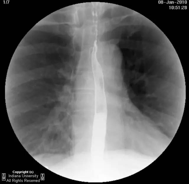 【病例】食管壁内假性憩室并长节段狭窄1例