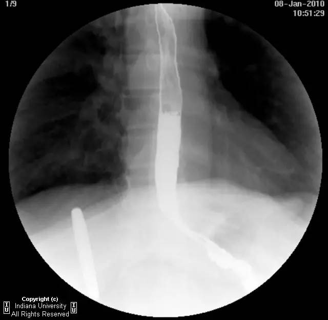 【病例】食管壁内假性憩室并长节段狭窄1例