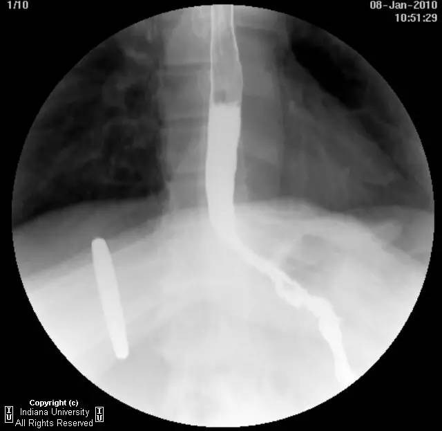 【病例】食管壁内假性憩室并长节段狭窄1例