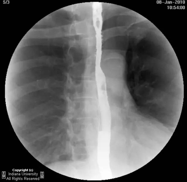 【病例】食管壁内假性憩室并长节段狭窄1例
