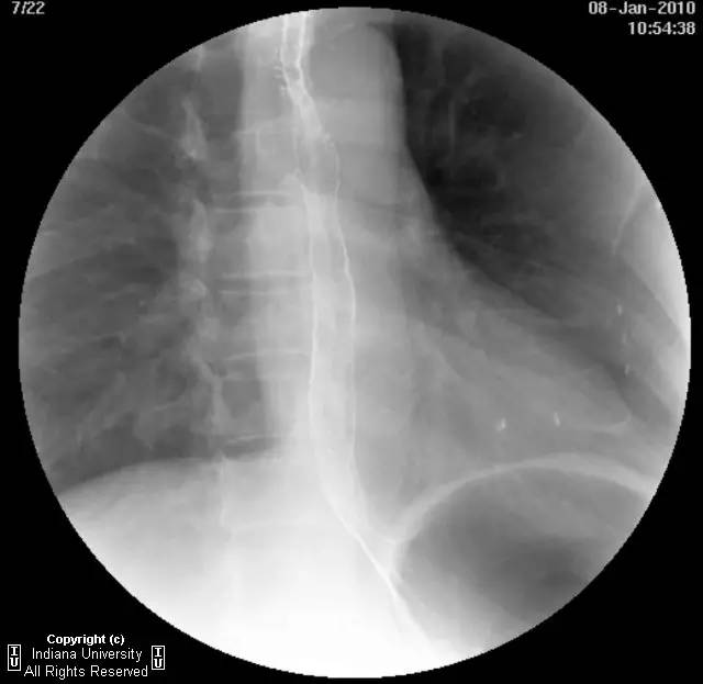 【病例】食管壁内假性憩室并长节段狭窄1例