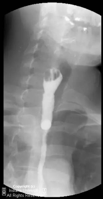 【病例】食管壁内假性憩室并长节段狭窄1例