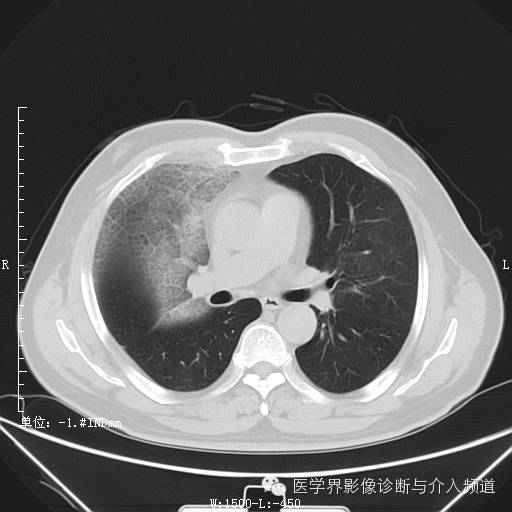 【病例】右肺上叶腺癌1例CT影像表现
