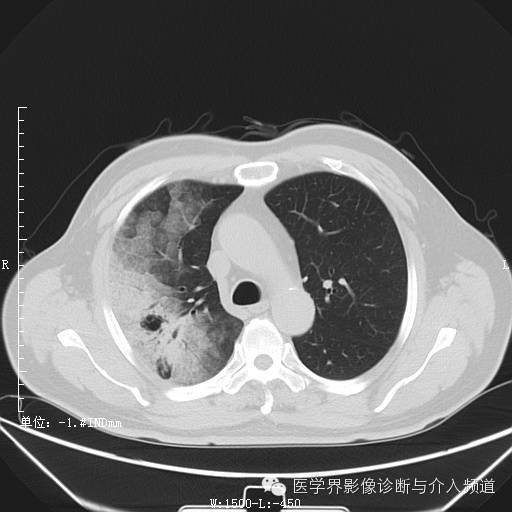 【病例】右肺上叶腺癌1例CT影像表现