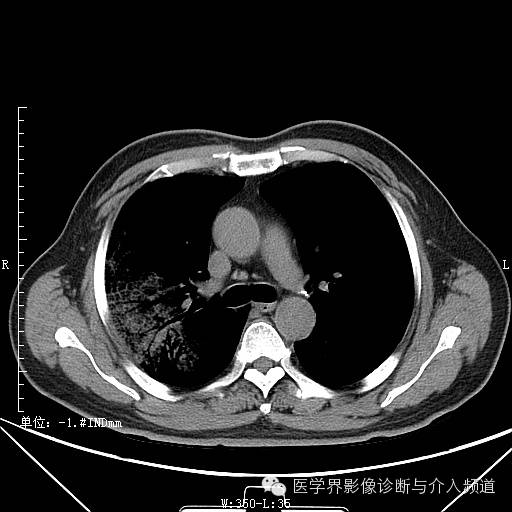 【病例】右肺上叶腺癌1例CT影像表现