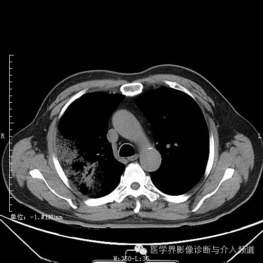 【病例】右肺上叶腺癌1例CT影像表现