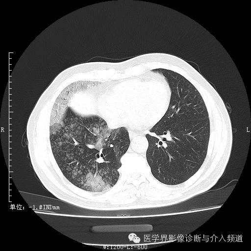 【病例】右肺上叶腺癌1例CT影像表现